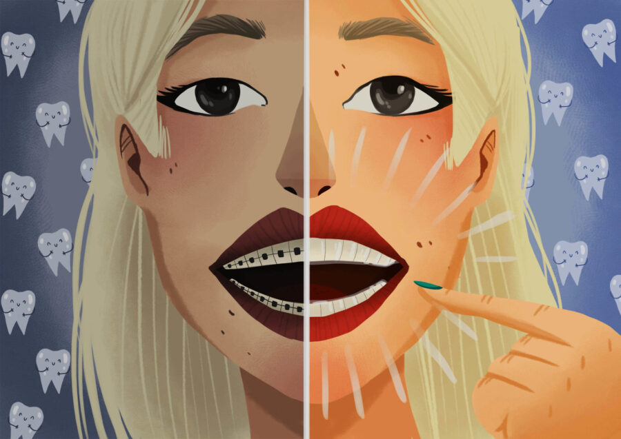 Closeup of a blonde teenager with braces on one side and Invisalign on the other as a comparison